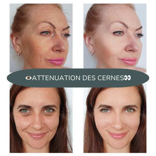 Avant/ Aprés utilisation du masseur oculaire ocucare. On peut voir les cernes atténués au bout de plusieurs utilisations.